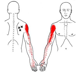 Infraspinatus trigger points